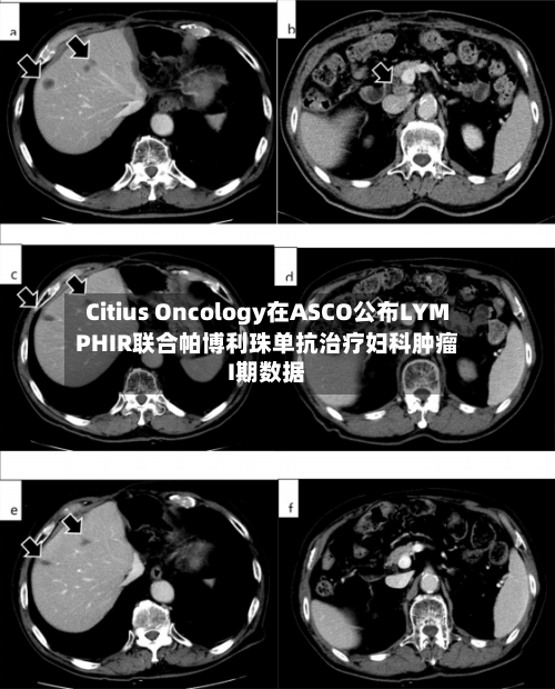 Citius Oncology在ASCO公布LYMPHIR联合帕博利珠单抗治疗妇科肿瘤I期数据-第2张图片